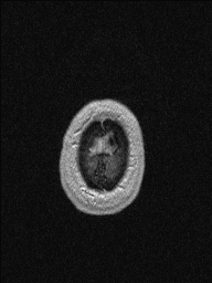 Central neurocytoma (Radiopaedia 56690-63469 Axial T1 C+ 157).jpg