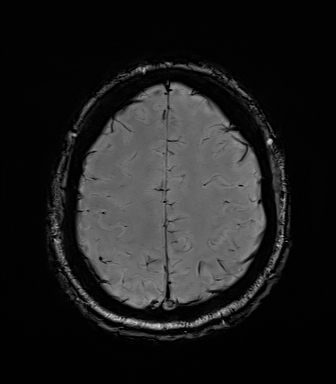 Central neurocytoma (Radiopaedia 71068-81303 Axial SWI 52).jpg