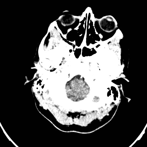 Central neurocytoma (Radiopaedia 84497-99871 B 1).jpg