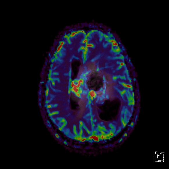 Central neurocytoma (Radiopaedia 84497-99872 Axial Perfusion 113).jpg