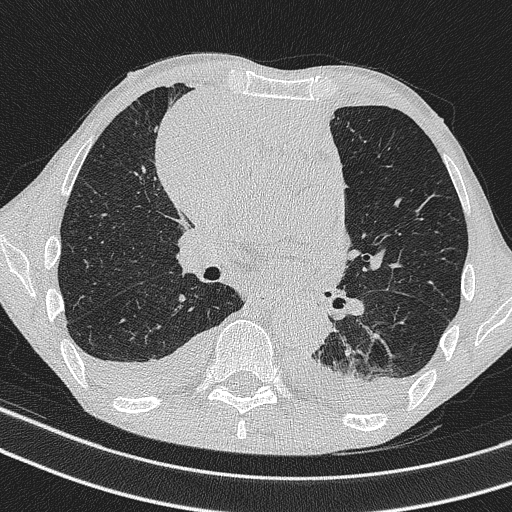 Central venous catheter tip extravasation (Radiopaedia 82828-97113 Axial lung window 45).jpg