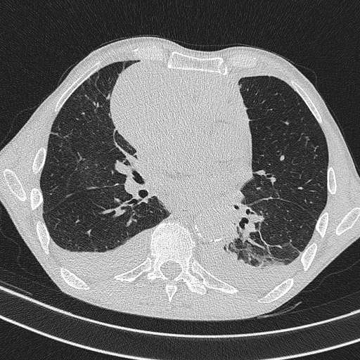 Central venous catheter tip extravasation (Radiopaedia 82828-97113 Axial lung window 48).jpg