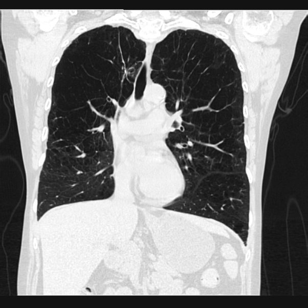 Centrilobular pulmonary emphysema (Radiopaedia 24495-24789 Coronal lung window 34).jpg