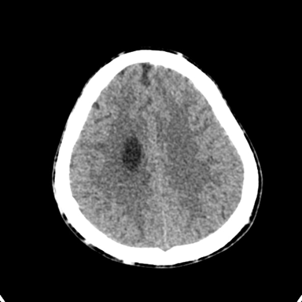 Cerebellar abscess secondary to mastoiditis (Radiopaedia 26284-26412 Axial non-contrast 124).jpg