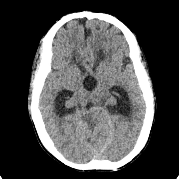 Cerebellar abscess secondary to mastoiditis (Radiopaedia 26284-26412 Axial non-contrast 64).jpg
