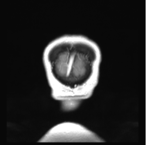 Cerebellar ependymoma complicated by post-operative subdural hematoma (Radiopaedia 83322-97736 Coronal T1 C+ 57).png