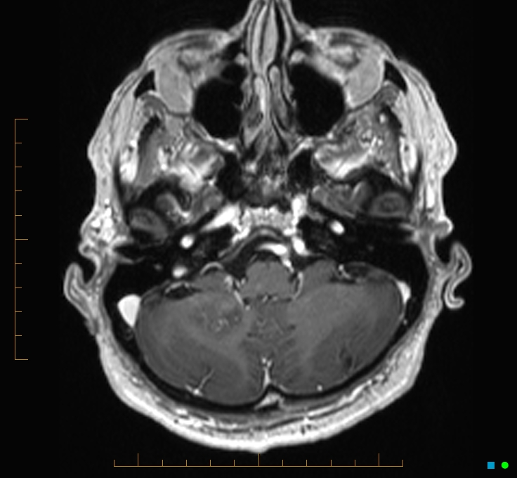 Cerebellar gangliocytoma (Radiopaedia 65377-74422 Axial T1 C+ 19).jpg