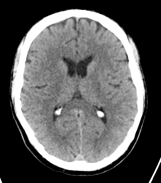 File:Cerebellar hemorrhage (Radiopaedia 37000-38669 Axial non-contrast 22).png
