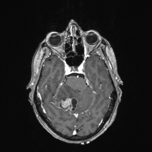 Cerebellar metastases (Radiopaedia 24038-24249 Axial T1 C+ 29).jpg