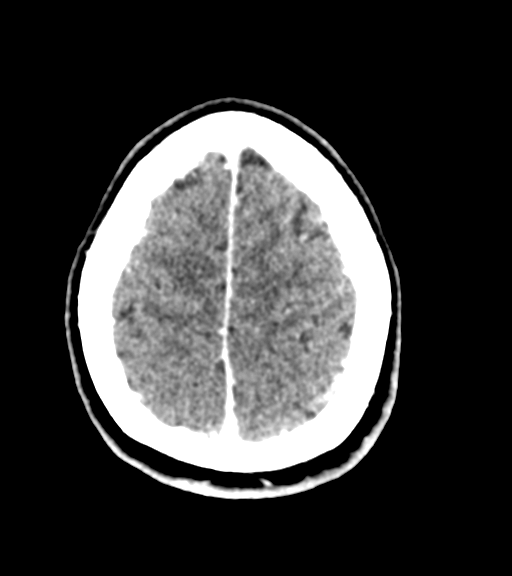 Cerebellar metastases - colorectal adenocarcinoma (Radiopaedia 40947-43652 Axial C+ 55).png
