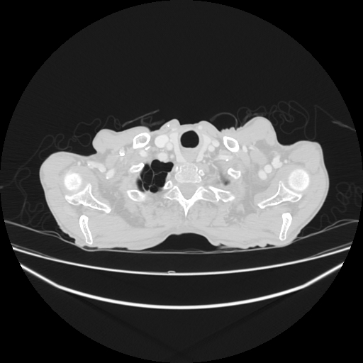 File:Cerebellar metastasis - lung tumor (Radiopaedia 69317-79150 Axial lung window 1).jpg