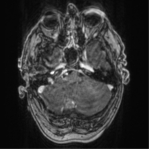 Cerebellar metastasis from lung adenocarcinoma (Radiopaedia 86690-102829 Axial T1 C+ 19).png