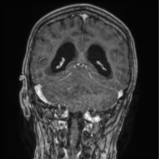 Cerebellar metastasis from lung adenocarcinoma (Radiopaedia 86690-102829 Coronal T1 C+ 38).png