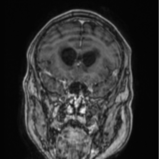 Cerebellar metastasis from lung adenocarcinoma (Radiopaedia 86690-102829 Coronal T1 C+ 69).png
