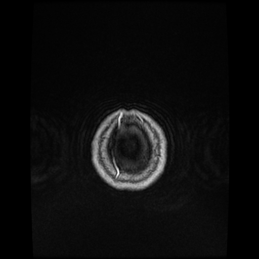 Cerebellar metastasis of pulmonary adenocarcinoma, cavernous venous malformation, and developmental venous anomaly (Radiopaedia 85827-101661 Axial T1 C+ 89).jpg