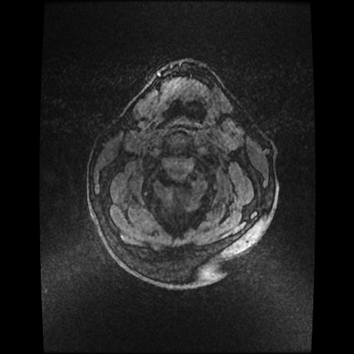 Cerebellar metastasis of pulmonary adenocarcinoma, cavernous venous malformation, and developmental venous anomaly (Radiopaedia 85827-101661 Axial T1 C+ 95).jpg