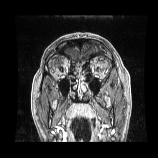 Cerebellar metastasis of pulmonary adenocarcinoma, cavernous venous malformation, and developmental venous anomaly (Radiopaedia 85827-101661 Coronal T1 C+ 80).jpg