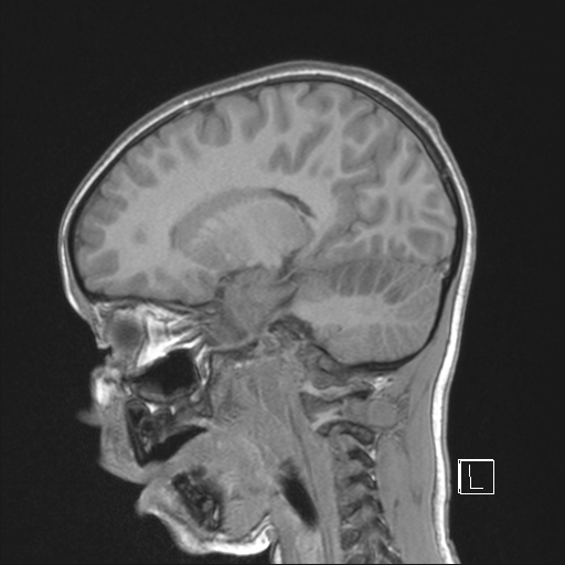 Cerebellar stroke (Radiopaedia 32202-33150 Sagittal T1 C+ 20).png