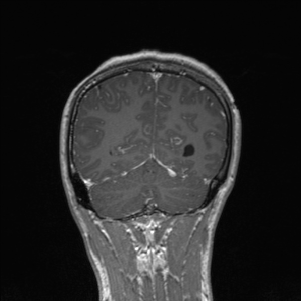 Cerebral abscess (Radiopaedia 24212-24478 Coronal T1 C+ 159).jpg
