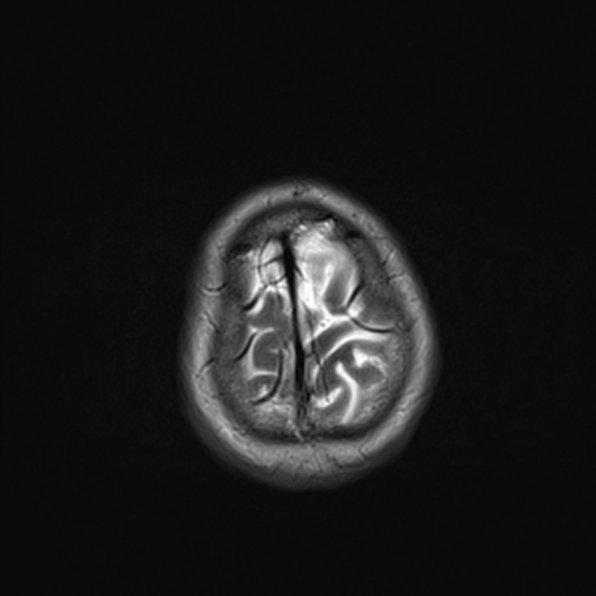 Cerebral abscess (Radiopaedia 26111-26247 Axial T2 53).jpg