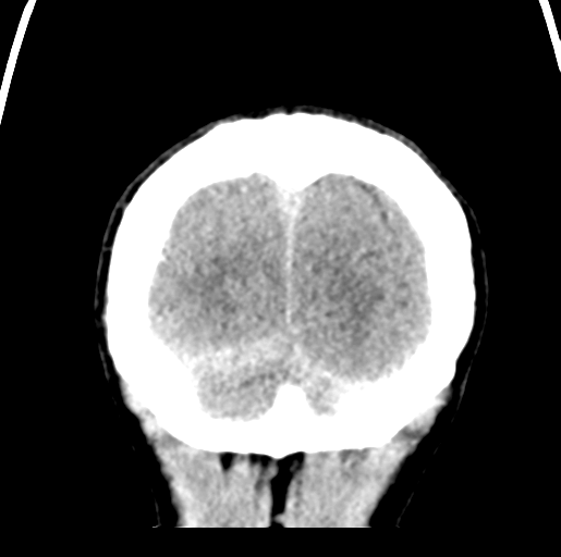 Cerebral abscess (Radiopaedia 60342-68008 Coronal non-contrast 58).png