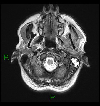 File:Cerebral abscess and subdural empyema (Radiopaedia 84436-99779 Axial T2 2).jpg
