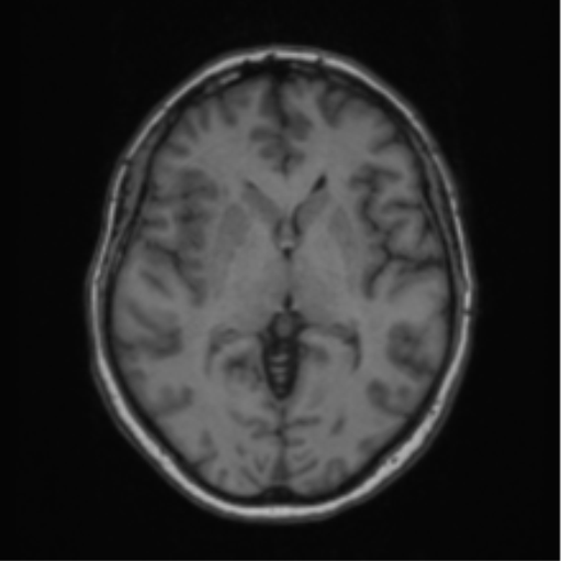 Cerebral abscess from pulmonary arteriovenous malformation (Radiopaedia 86275-102291 Axial T1 38).png