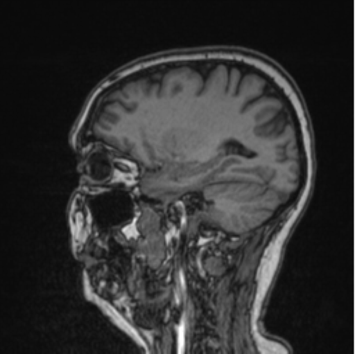 Cerebral abscess from pulmonary arteriovenous malformation (Radiopaedia 86275-102291 Sagittal T1 40).png