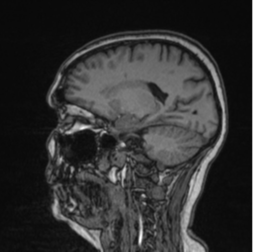Cerebral abscess from pulmonary arteriovenous malformation (Radiopaedia 86275-102291 Sagittal T1 44).png