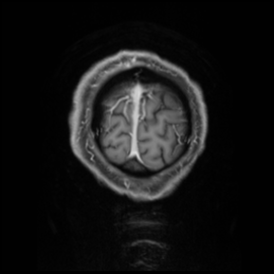 Cerebral abscess with ventriculitis (Radiopaedia 78965-91878 Coronal T1 C+ 61).jpg
