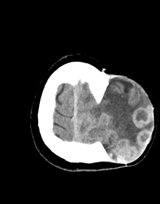 Cerebral abscesses (Radiopaedia 70458-80568 Axial non-contrast 53).jpg