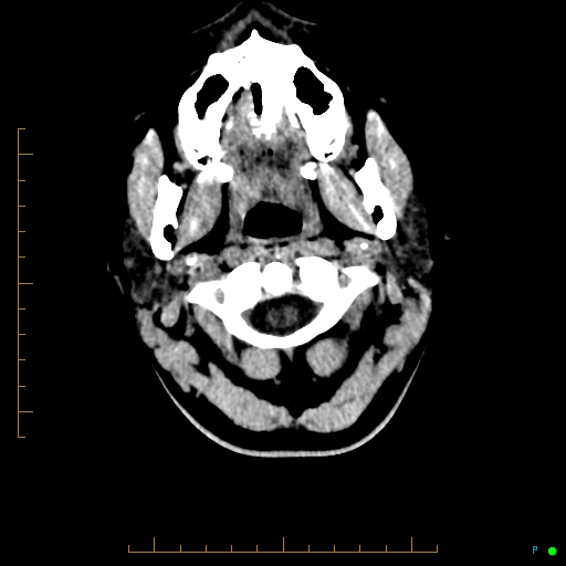 Cerebral arteriovenous malformation (AVM) (Radiopaedia 78162-90706 Axial non-contrast 3).jpg