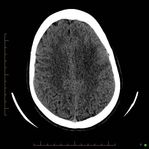 Cerebral arteriovenous malformation (AVM) (Radiopaedia 78162-90706 Axial non-contrast 46).jpg