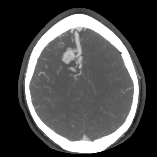 Cerebral arteriovenous malformation (Radiopaedia 39259-41505 AX CEREBRAL CTA 43).png