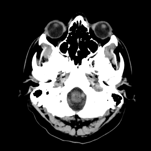 File:Cerebral arteriovenous malformation (Radiopaedia 39259-41505 Brain Ax 5mm 3).png