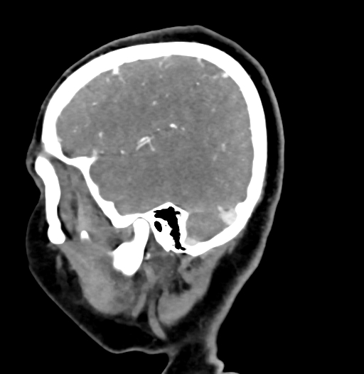 Cerebral arteriovenous malformation (Radiopaedia 73830-84645 D 19).jpg