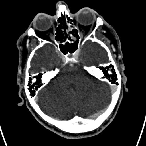Cerebral arteriovenous malformation (Radiopaedia 78188-90746 Axial C+ delayed 48).jpg