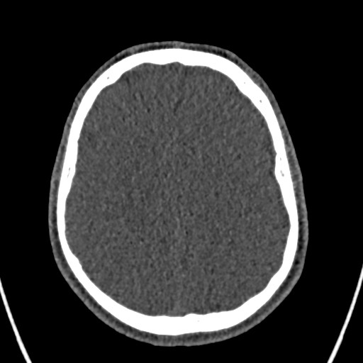 Cerebral arteriovenous malformation (Radiopaedia 78188-90746 Axial non-contrast 127).jpg