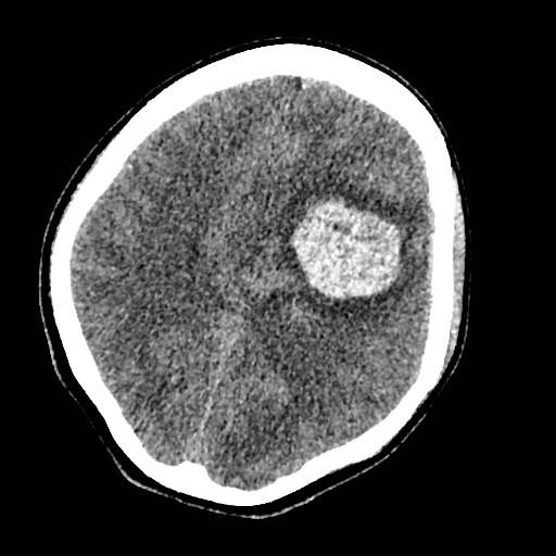 Cerebral arteriovenous malformation (Radiopaedia 79677-92887 Axial non-contrast 26).jpg