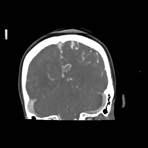 File:Cerebral arteriovenous malformation (Radiopaedia 79677-92888 B 35).jpg