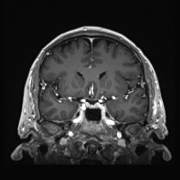 Cerebral arteriovenous malformation (Radiopaedia 84015-99245 Coronal T1 C+ 64).jpg