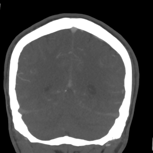 File:Cerebral arteriovenous malformation (Spetzler-Martin grade 2) (Radiopaedia 41262-44076 F 49).png