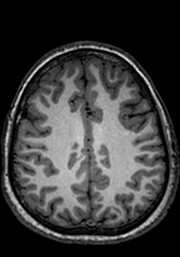 File:Cerebral arteriovenous malformation at posterior body of corpus callosum (Radiopaedia 74111-84925 Axial T1 80).jpg