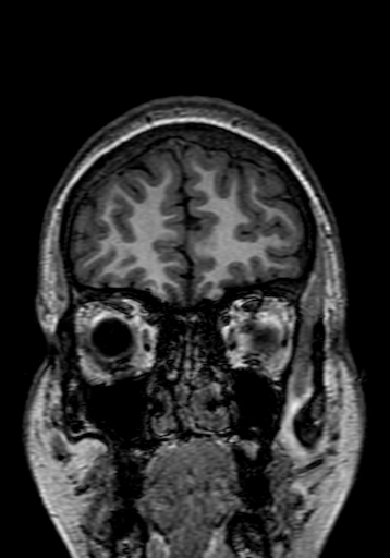 Cerebral arteriovenous malformation at posterior body of corpus callosum (Radiopaedia 74111-84925 Coronal T1 29).jpg