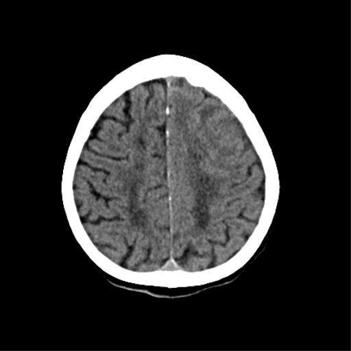 File:Cerebral arteriovenous malformation with lobar hemorrhage (Radiopaedia 44725-48510 Axial non-contrast 31).png