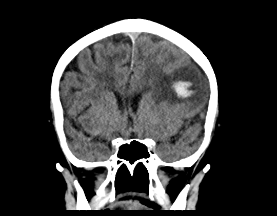 Cerebral arteriovenous malformation with lobar hemorrhage (Radiopaedia 44725-48510 Coronal non-contrast 21).png