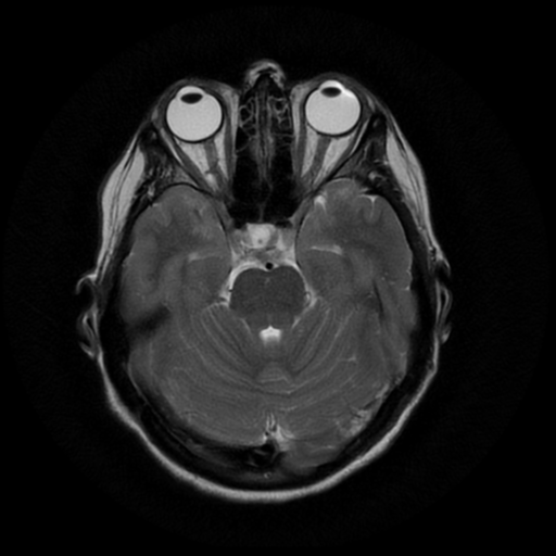 File:Cerebral autosomal dominant arteriopathy with subcortical infarcts and leukoencephalopathy (CADASIL) (Radiopaedia 41018-43763 Ax T2 PROP 7).png