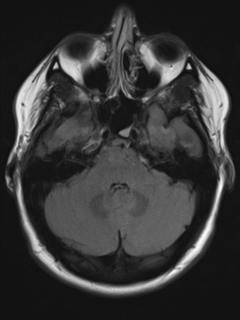 File:Cerebral cavernoma and development venous anomaly (Radiopaedia 37603-39482 Axial FLAIR 6).png