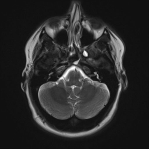 File:Cerebral cavernoma and development venous anomaly (Radiopaedia 37603-39482 Axial T2 5).png