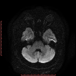 File:Cerebral cavernous malformation (Radiopaedia 26177-26306 Axial DWI 7).jpg